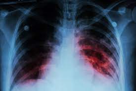 WHO Issues Tuberculosis Warning
